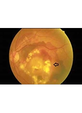 左眼老年黃斑部病變合併嚴重視網膜下出血（箭頭處）圖例。之照片